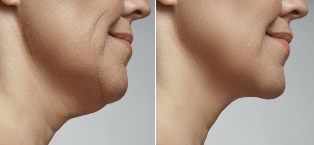 liposuccion-de-papada-cuello